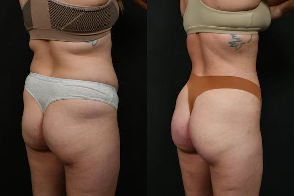 Butt Augmentation Before & After Gallery - Patient 413193 - Image 1