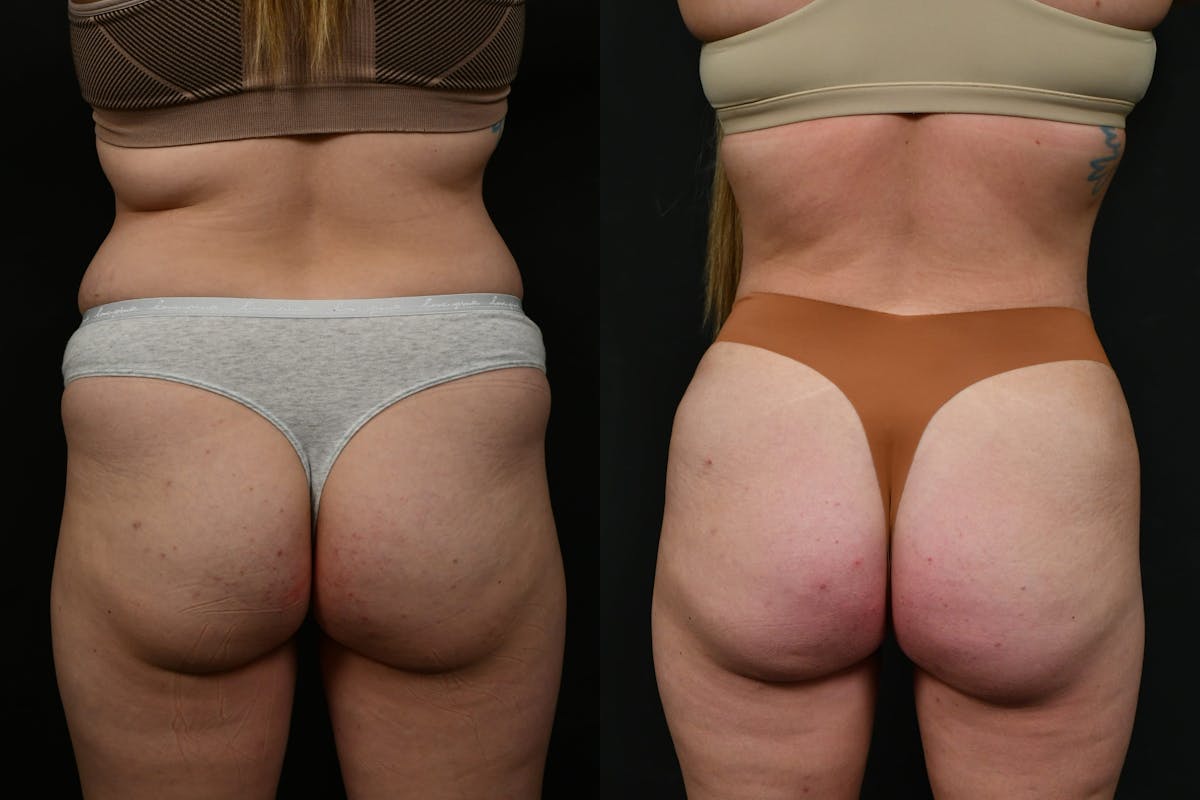 Butt Augmentation Before & After Gallery - Patient 413193 - Image 3
