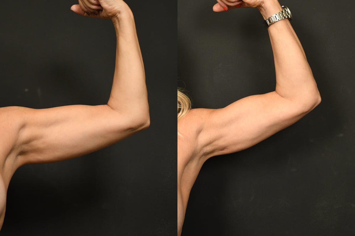 Liposuction / BodyTite Before & After Gallery - Patient 411510 - Image 2