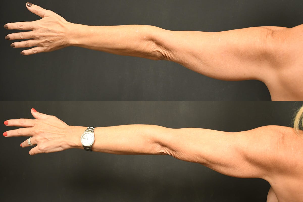 Liposuction / BodyTite Before & After Gallery - Patient 411510 - Image 4