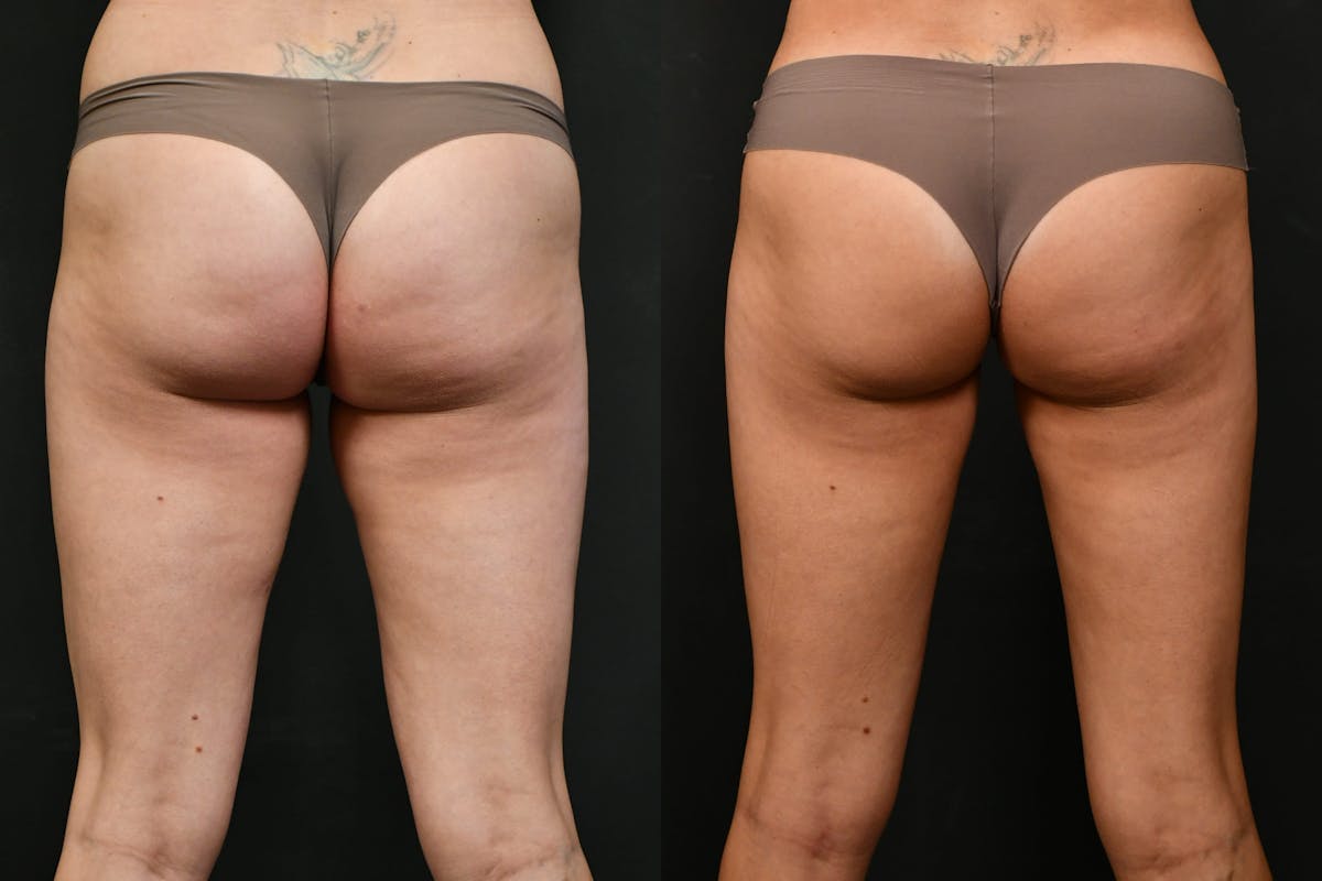 Liposuction / BodyTite Before & After Gallery - Patient 423144 - Image 1