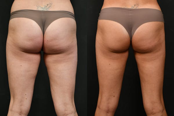 Liposuction / BodyTite Before & After Gallery - Patient 423144 - Image 1