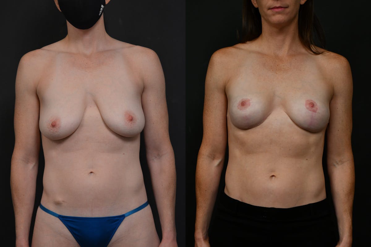 Breast Lift Before & After Gallery - Patient 128104 - Image 1