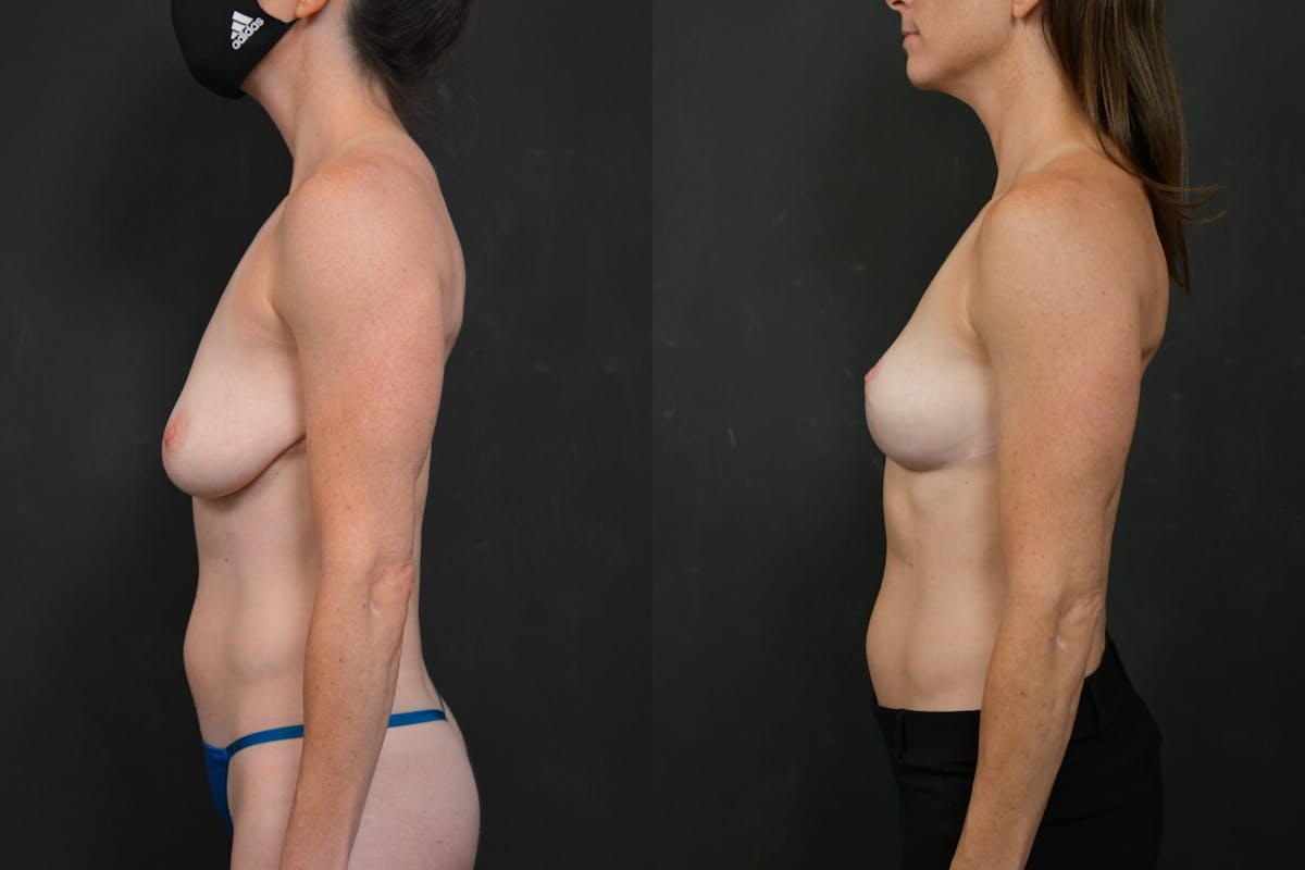 Breast Lift Before & After Gallery - Patient 128104 - Image 3