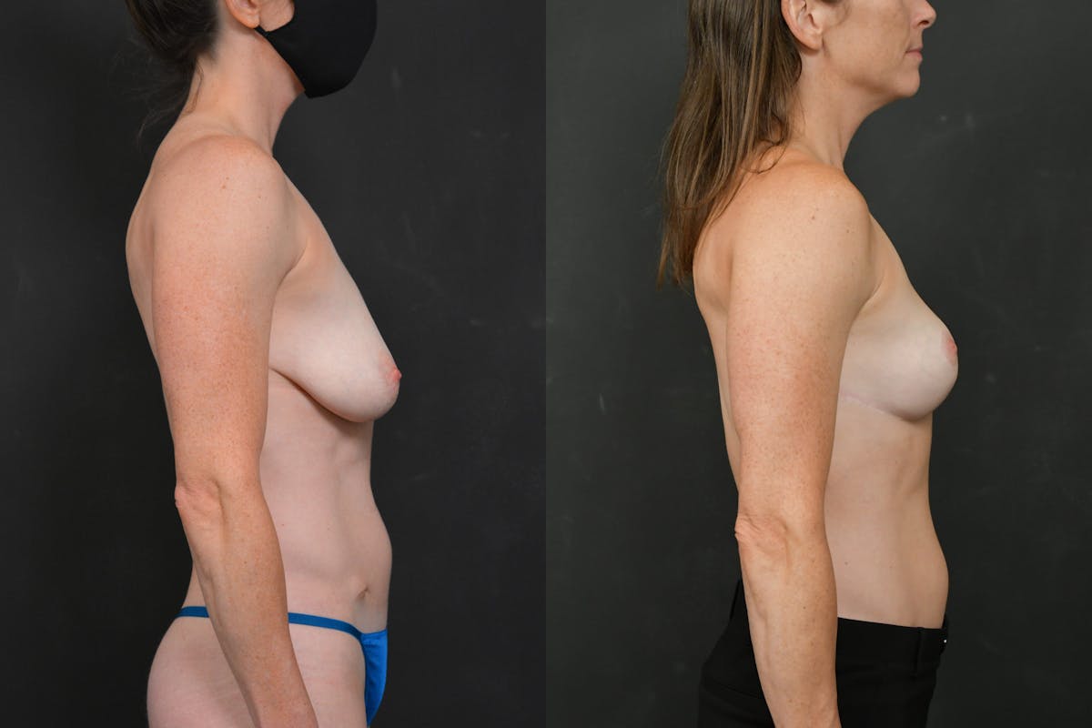 Breast Lift Before & After Gallery - Patient 128104 - Image 5