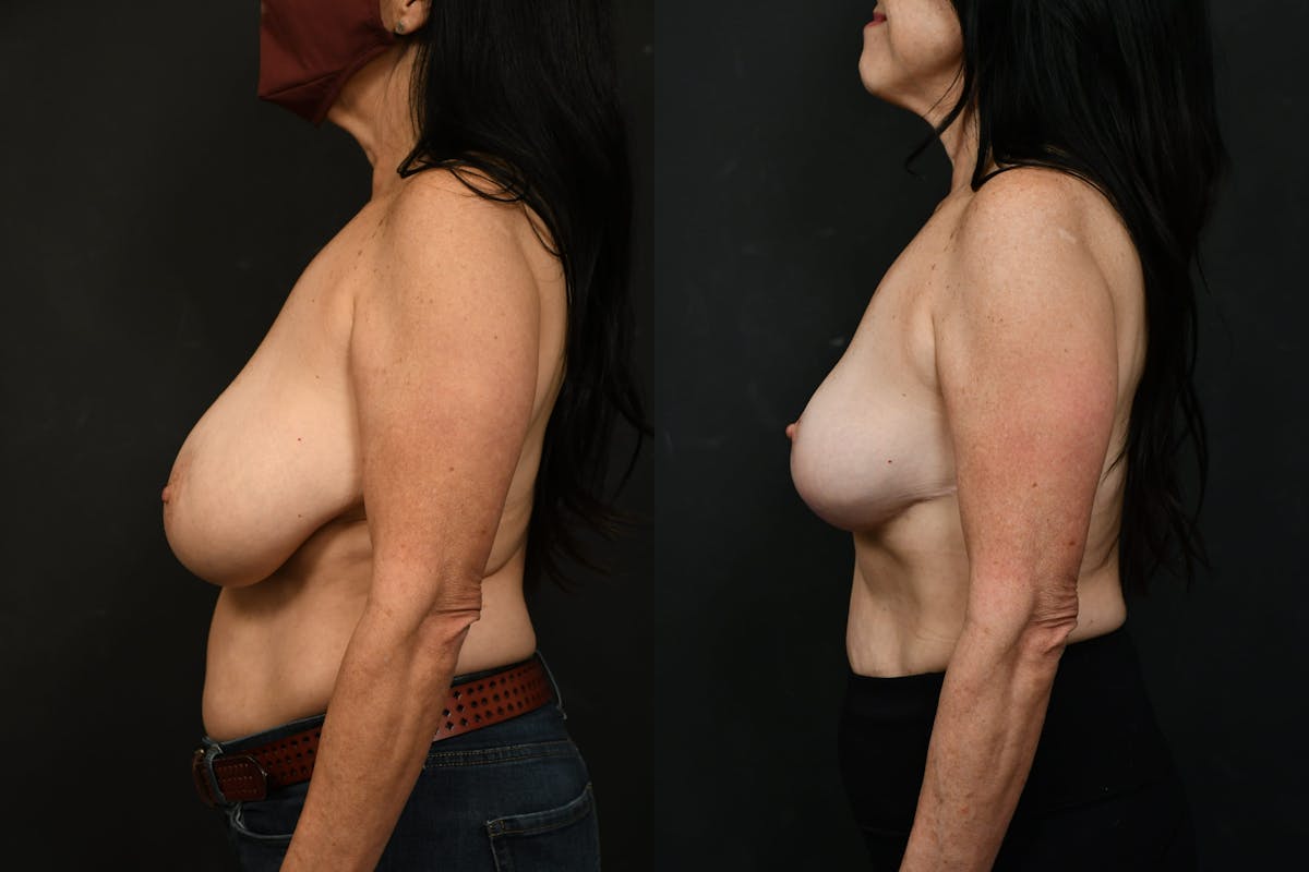 Breast Lift Before & After Gallery - Patient 416606 - Image 3
