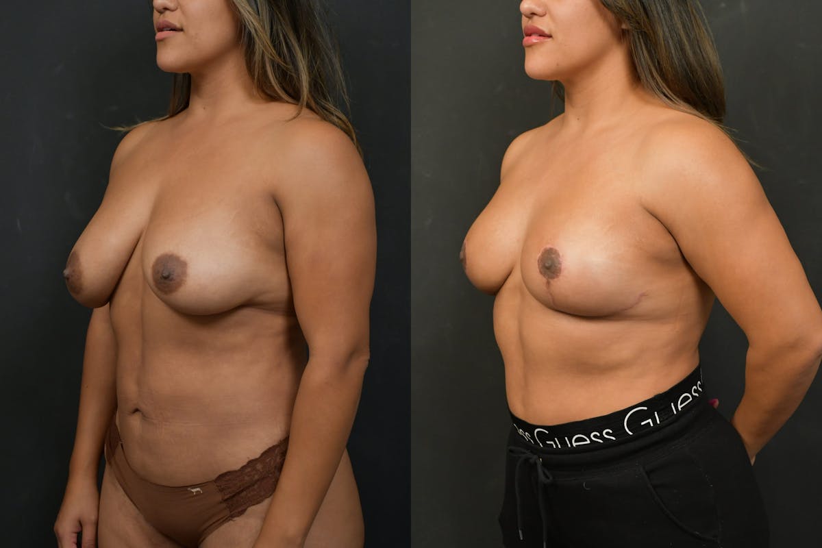 Breast Lift Before & After Gallery - Patient 752807 - Image 2