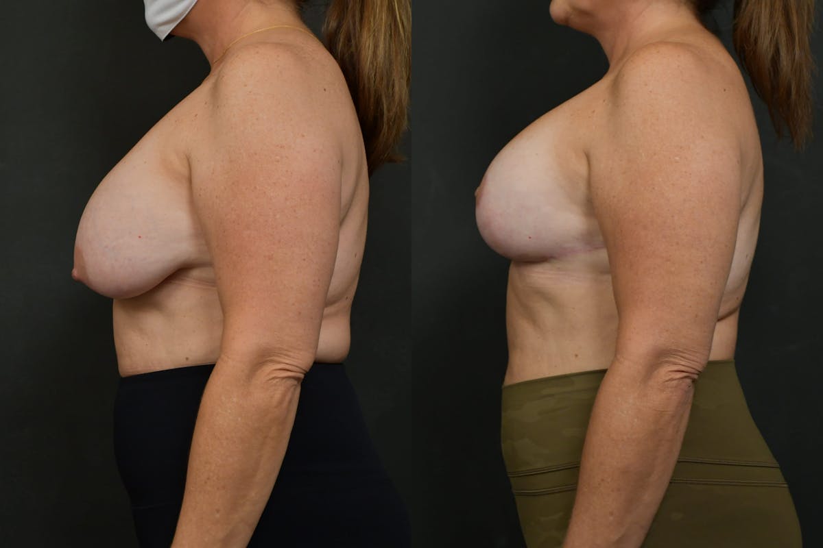 Breast Lift Before & After Gallery - Patient 160482 - Image 3