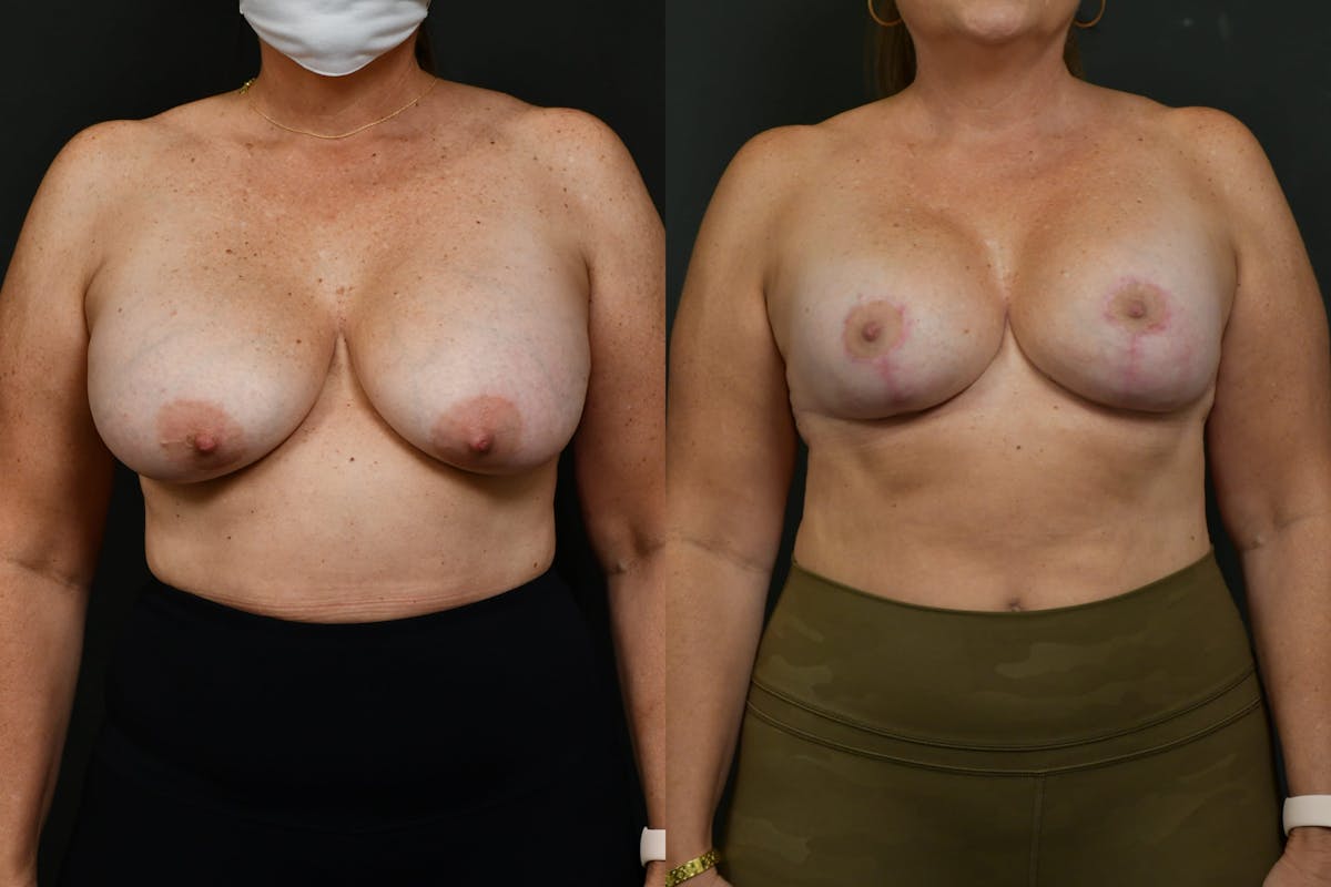 Breast Lift Before & After Gallery - Patient 160482 - Image 1