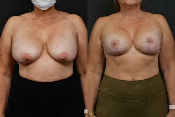 Breast Lift Before & After Gallery - Patient 160482 - Image 1