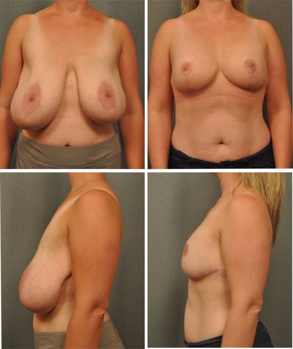 Before and after breast reduction
