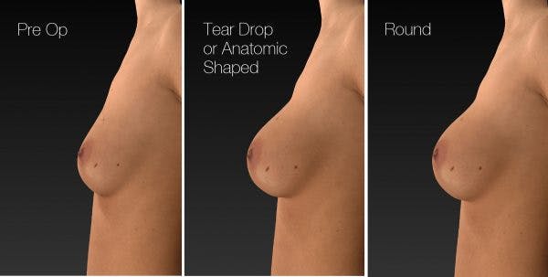 Type of breast implants