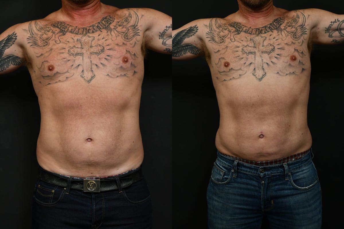 Male Liposuction Before & After Gallery - Patient 617510 - Image 1