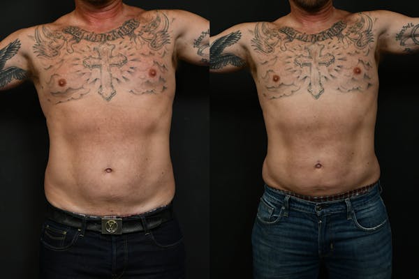 Male Liposuction Before & After Gallery - Patient 617510 - Image 1