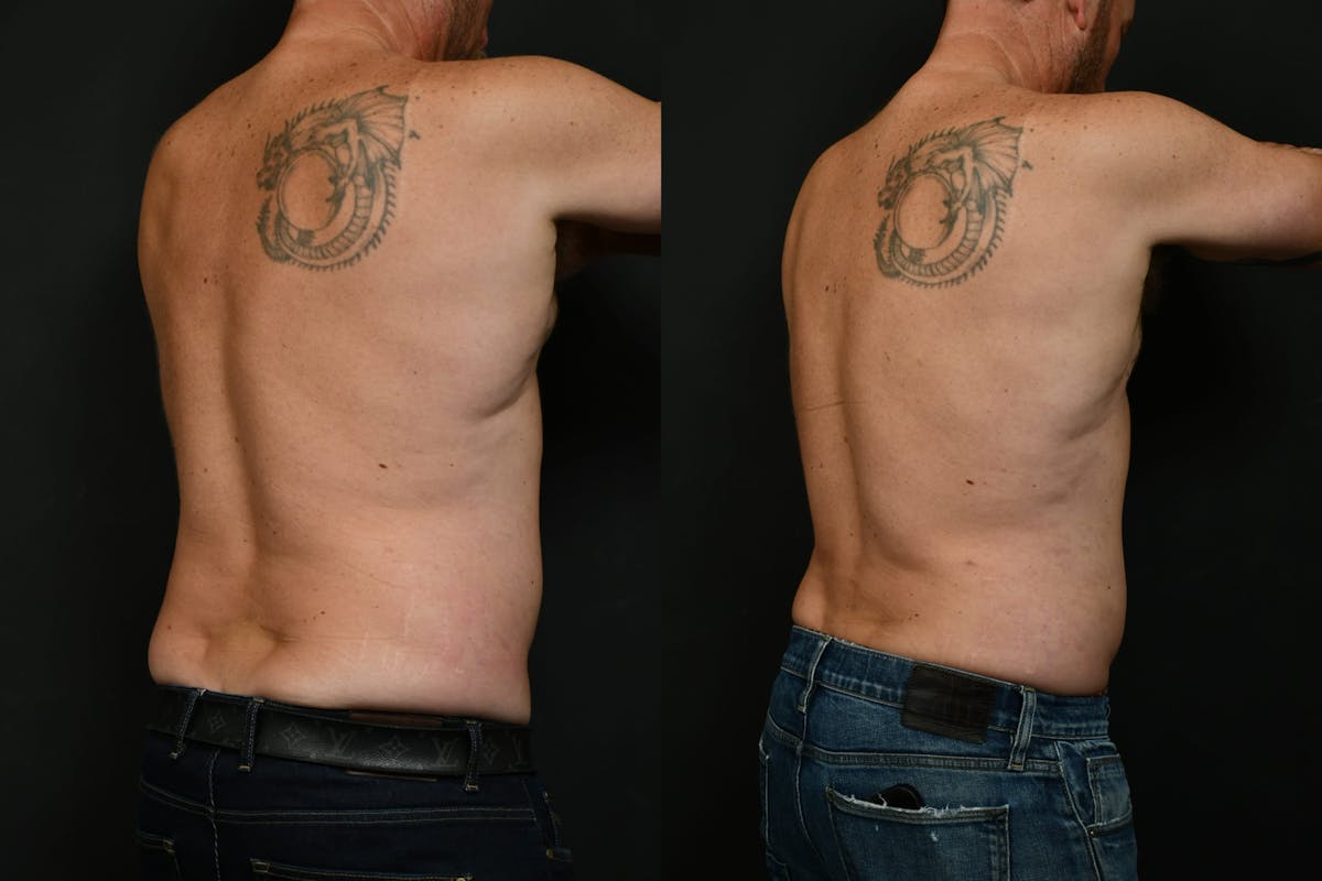Male Liposuction Before & After Gallery - Patient 617510 - Image 2