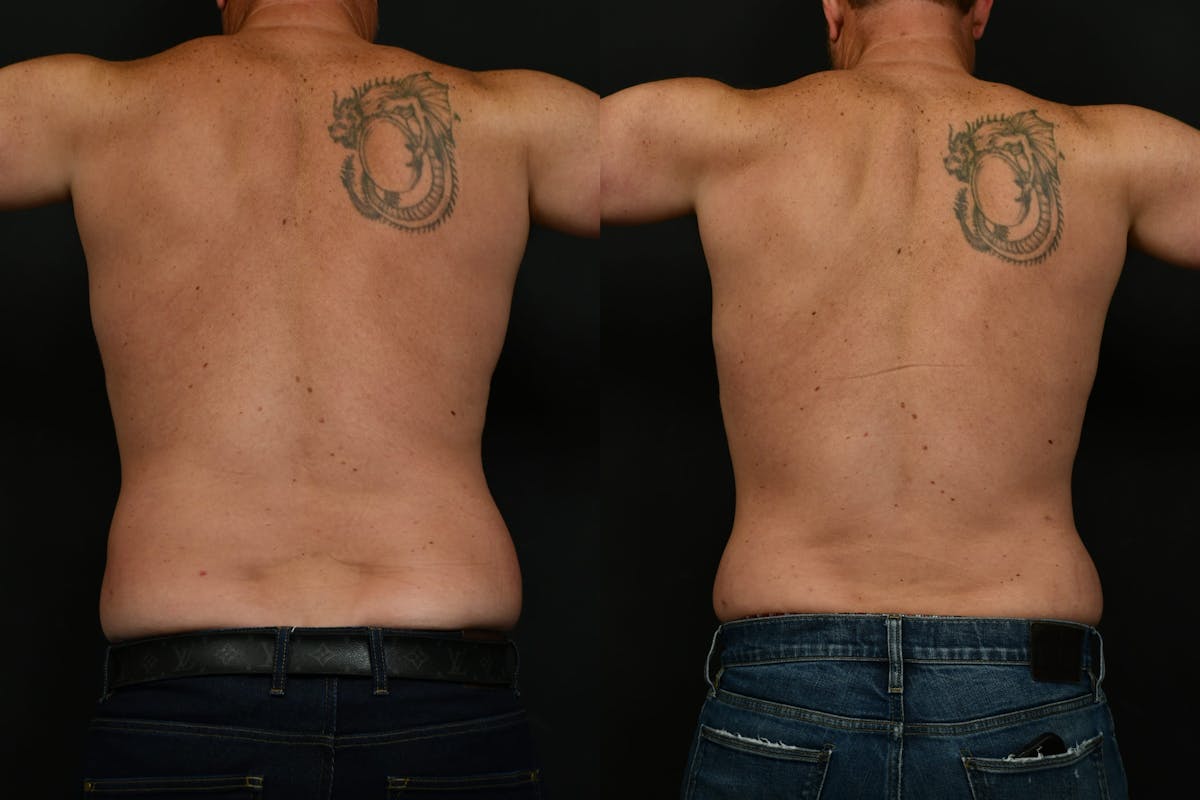 Male Liposuction Before & After Gallery - Patient 617510 - Image 3
