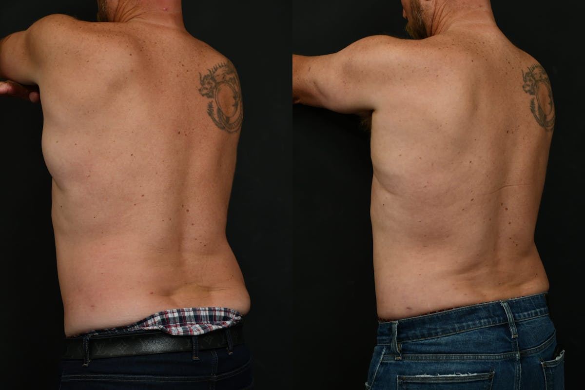 Male Liposuction Before & After Gallery - Patient 617510 - Image 4
