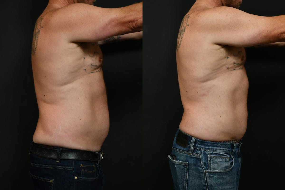 Male Liposuction Before & After Gallery - Patient 617510 - Image 5