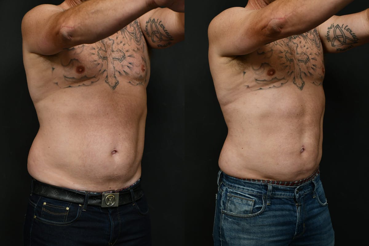 Male Liposuction Before & After Gallery - Patient 617510 - Image 6