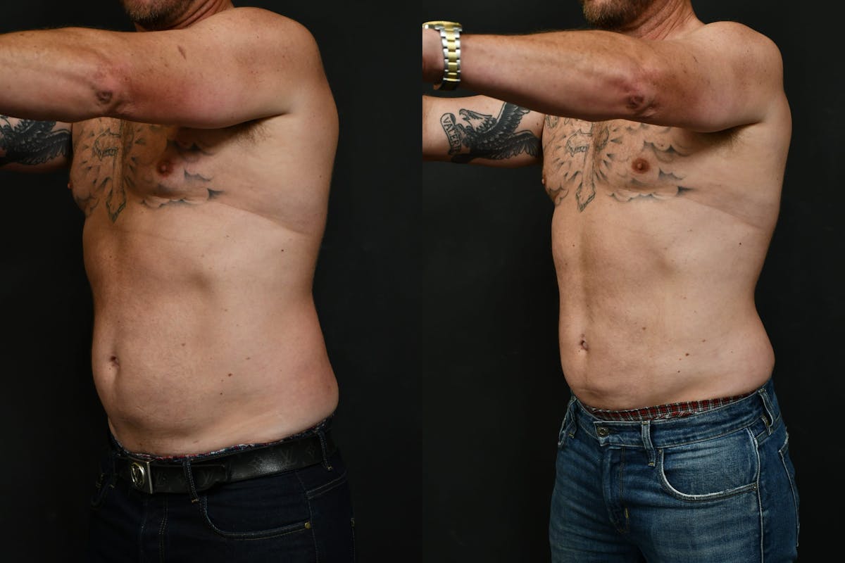 Male Liposuction Before & After Gallery - Patient 617510 - Image 8