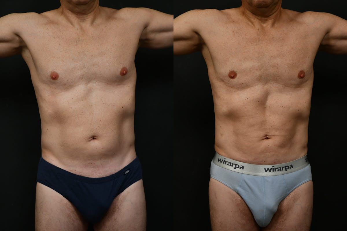 Male Liposuction Before & After Gallery - Patient 284397 - Image 1