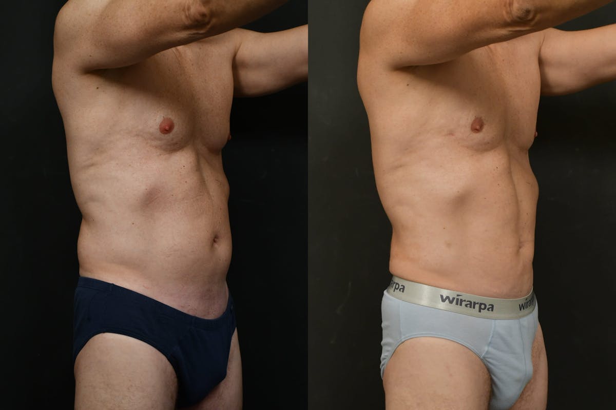 Male Liposuction Before & After Gallery - Patient 284397 - Image 2