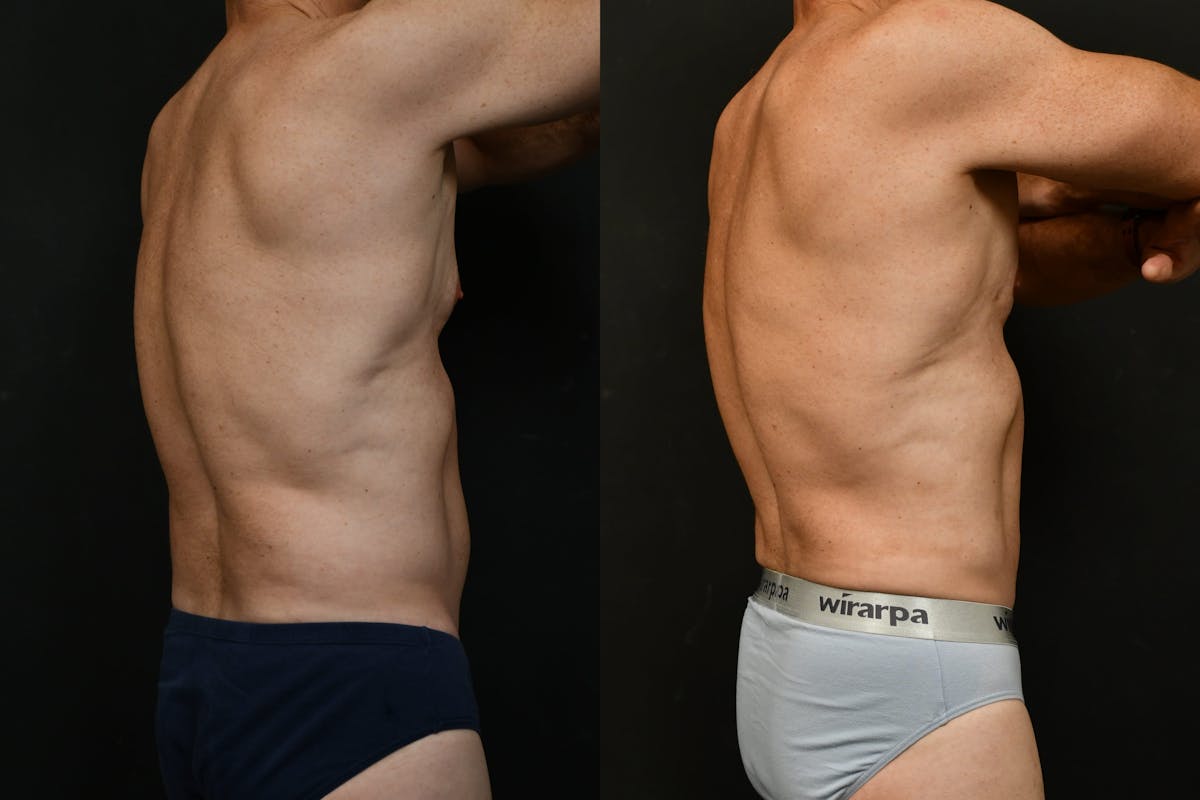 Male Liposuction Before & After Gallery - Patient 284397 - Image 4