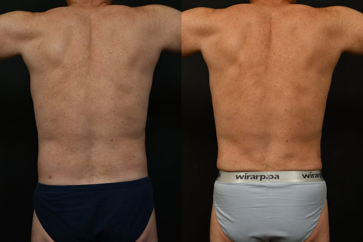 Male Liposuction Before & After Gallery - Patient 284397 - Image 5