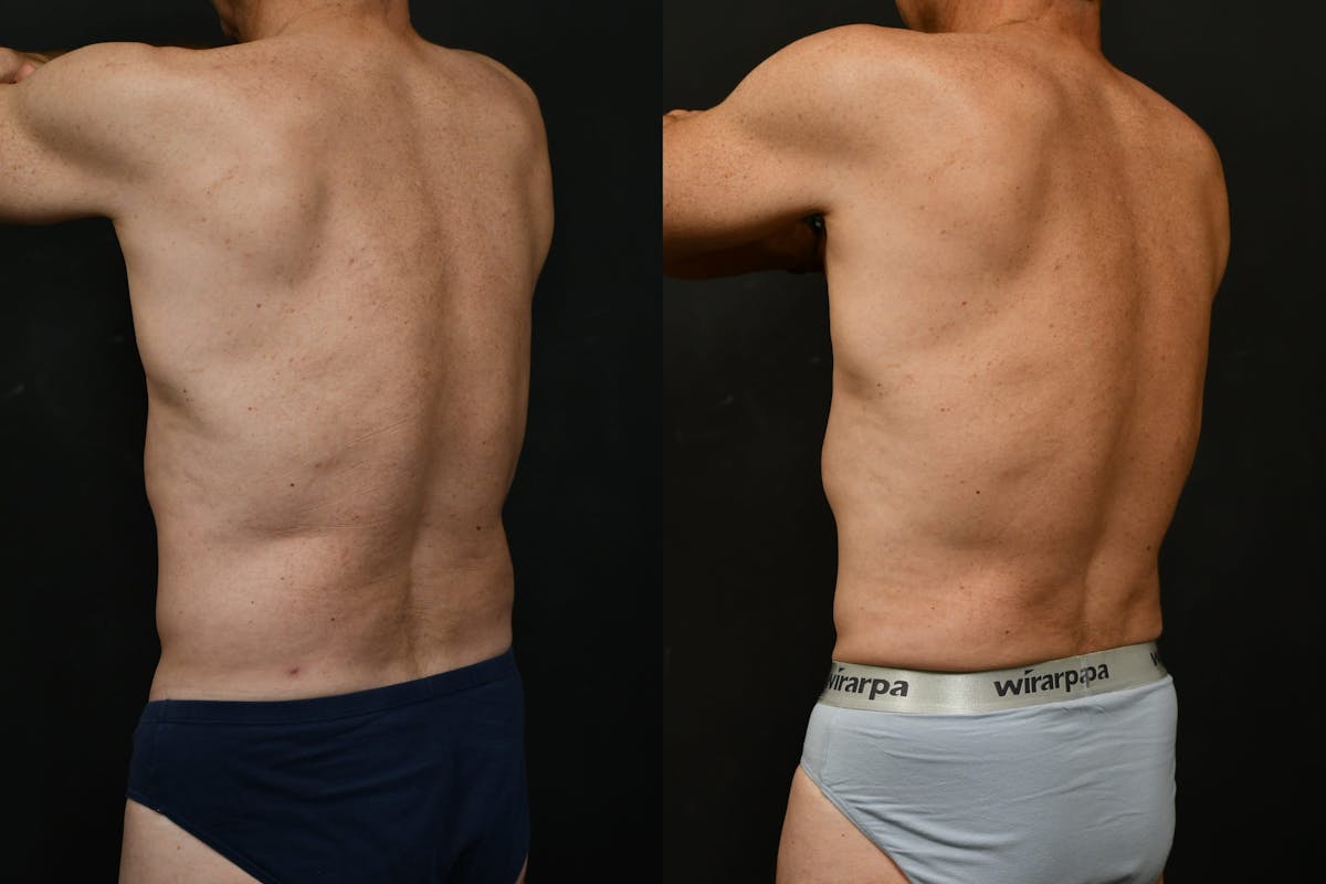Male Liposuction Before & After Gallery - Patient 284397 - Image 6