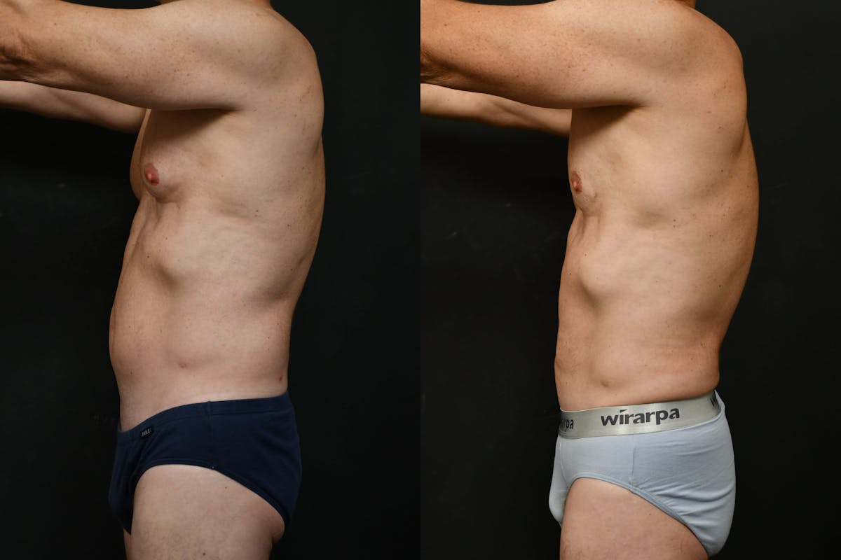 Male Liposuction Before & After Gallery - Patient 284397 - Image 7