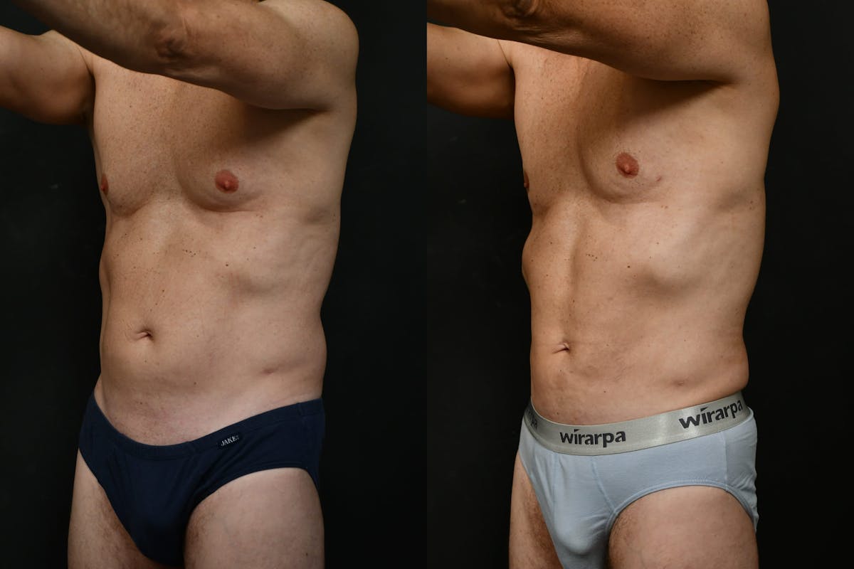 Male Liposuction Before & After Gallery - Patient 284397 - Image 8