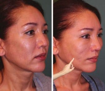 Woman with stretched skin