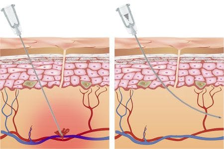 Micro-cannula vs needle