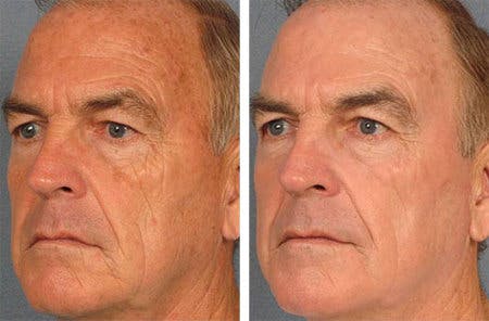 Before and After Brotox