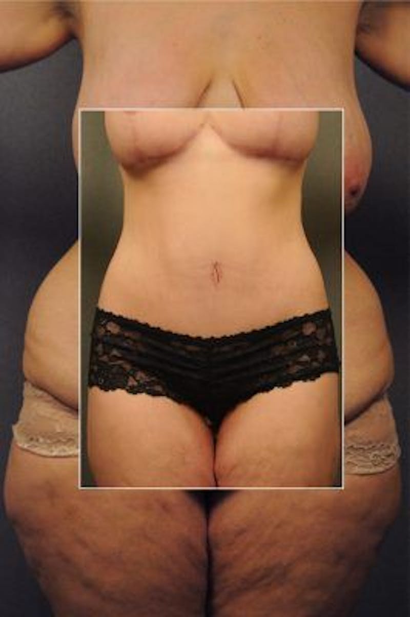 Before and after massive weight loss