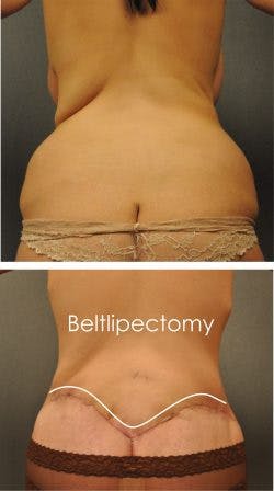 Before and after Body Lift