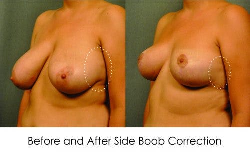 Before and after side boob correction