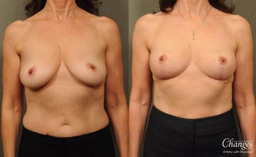 prevent saggy breasts