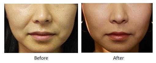 Before and after radiesse