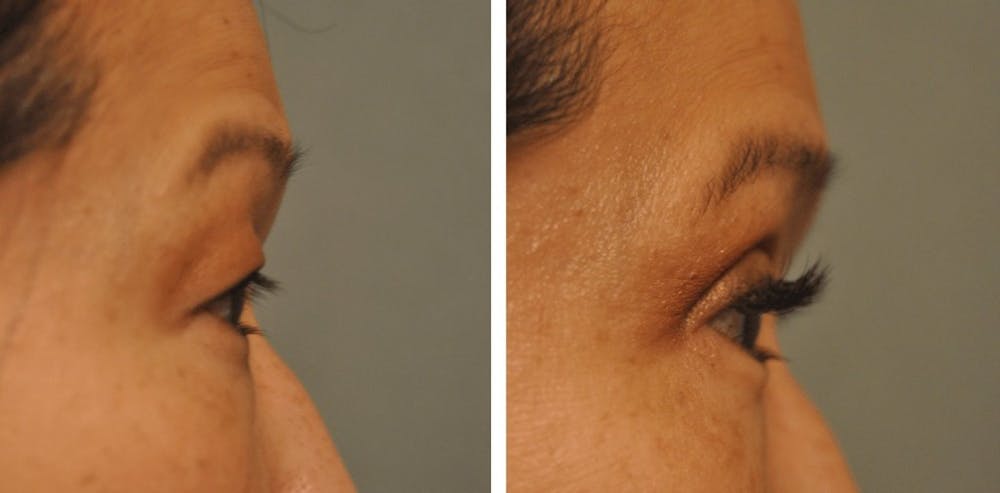 Asian Double Fold at Changes Plastic Surgery