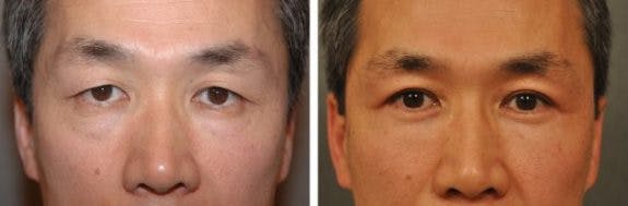 4-lid-blepharoplasty-15b