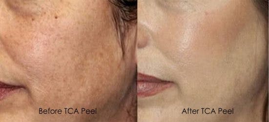 Before and After TCA peels