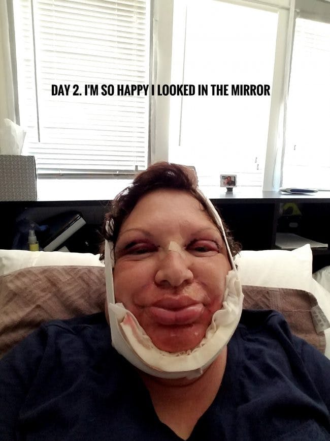 2 days after surgery