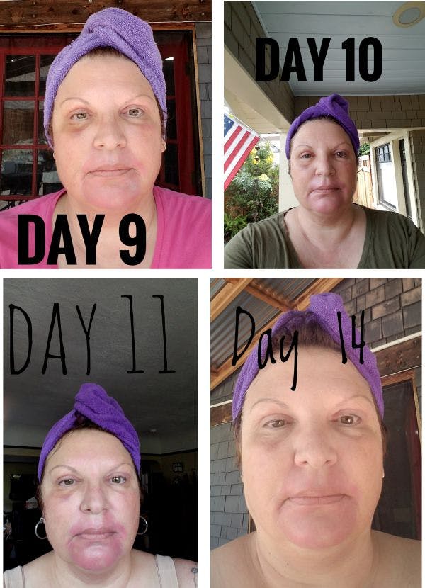 9-14 days after surgery