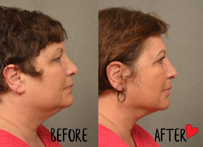 plastic surgery recovery journey