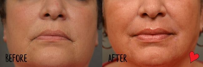 Before and after facial rejuvenation