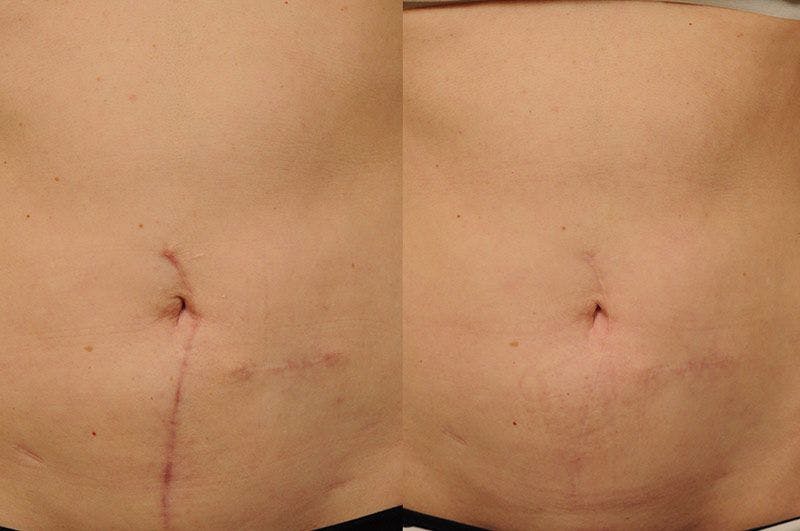 Before and after scar removal