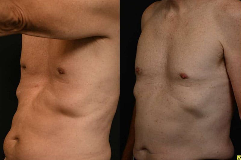 Before and after scar removal