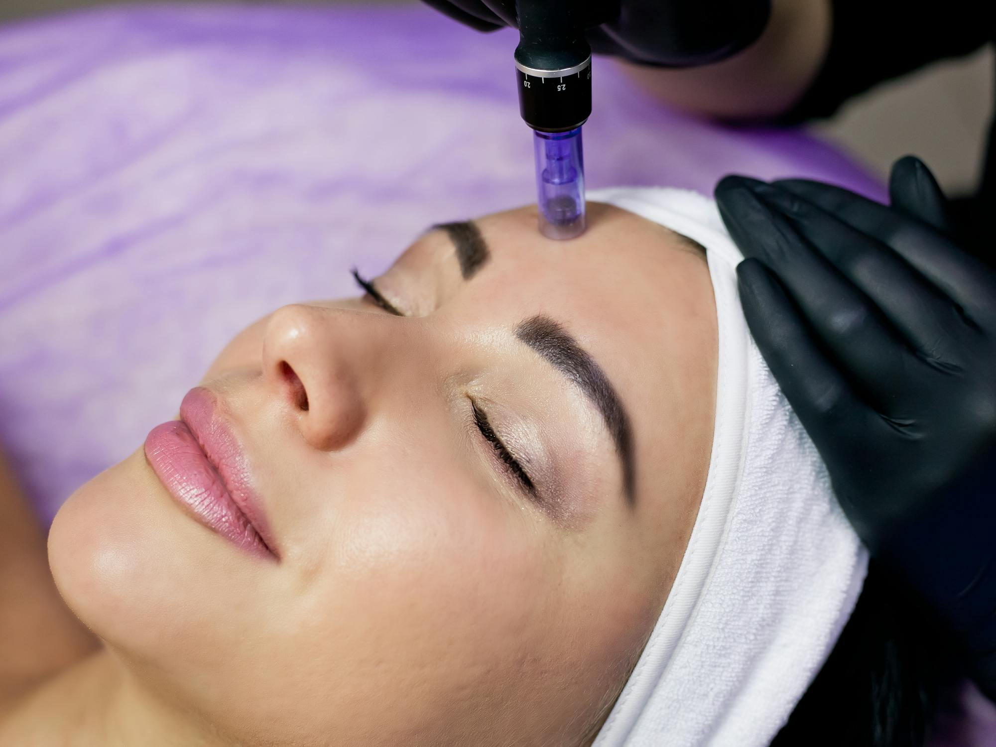 woman undergoing a microneedling procedure