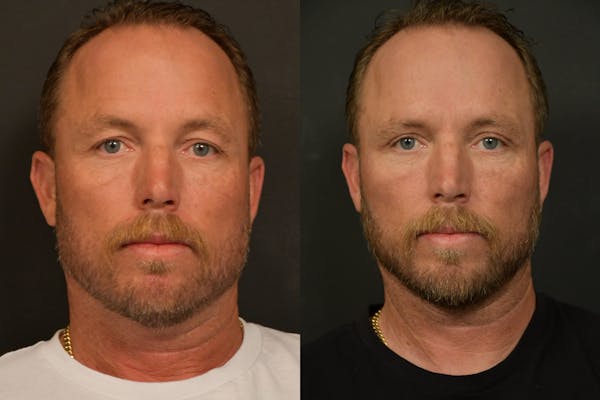 Male Eyelid Procedures Before & After Gallery - Patient 136558 - Image 1